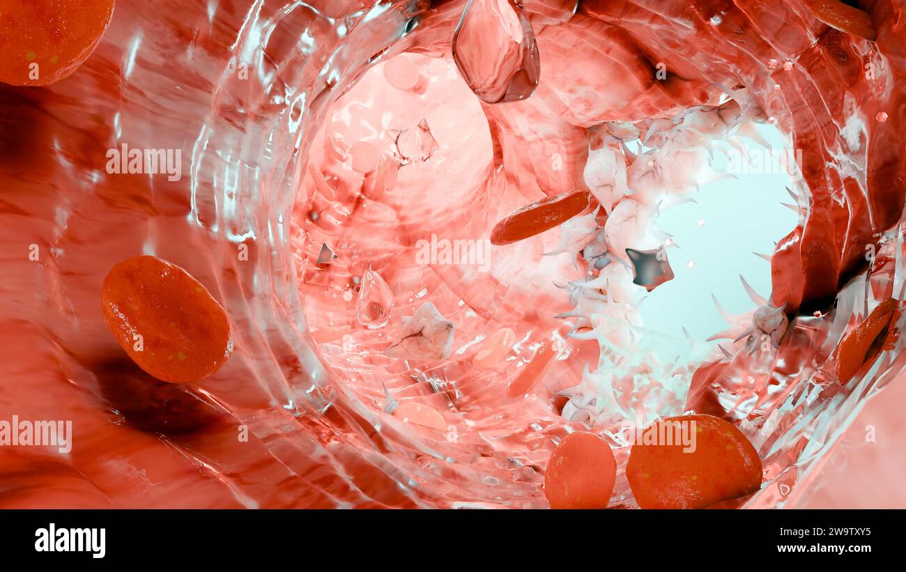 Hémostase. Globules rouges et plaquettes dans le vaisseau sanguin, vasoconstriction, processus de cicatrisation. Embolies de caillots hémorragiques, hémophilie. fibrino Banque D'Images