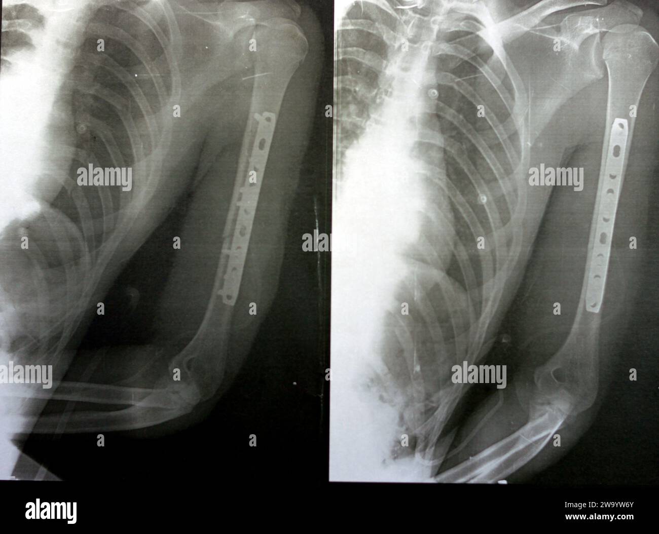 Radiographie simple montrant une fracture transversale de l'humérus gauche de l'arbre intermédiaire causée par un traumatisme direct dans un accident de voiture, gérée par réduction ouverte et fixa interne Banque D'Images