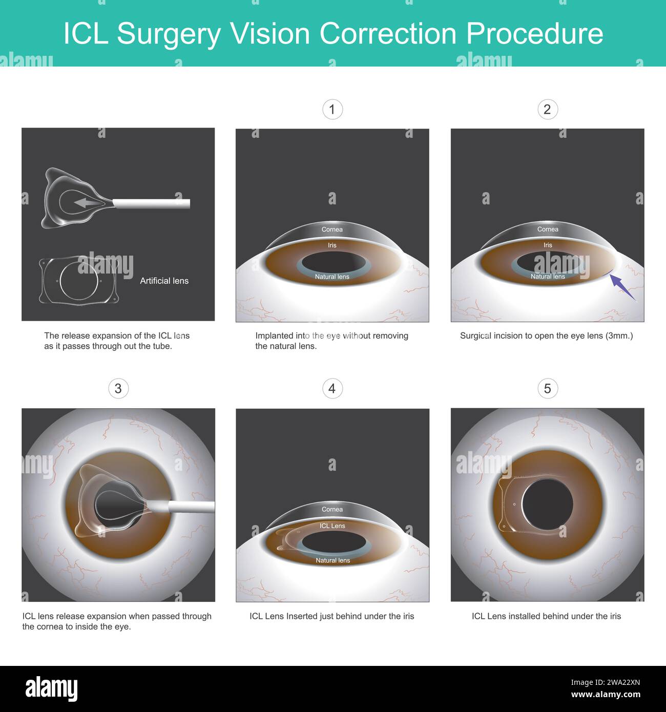 Procédure de correction de la vision en chirurgie ICL. Une nouvelle lentille oculaire qui peut être implantée dans l'œil sans retirer la lentille naturelle. Illustration de Vecteur