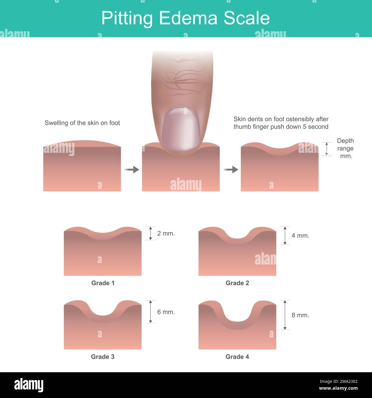 Echelle d'oedème piquant. Mesure de la plage de profondeur des bosses cutanées sur le pied après avoir poussé le pouce vers le bas 5 seconde. Illustration de Vecteur