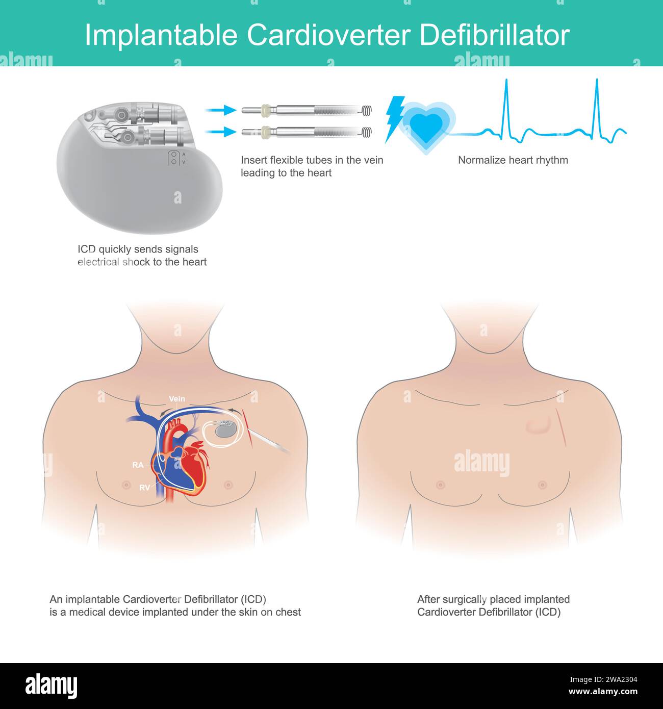 Défibrillateur implantable à cardioversion. Outil médical implanté sous