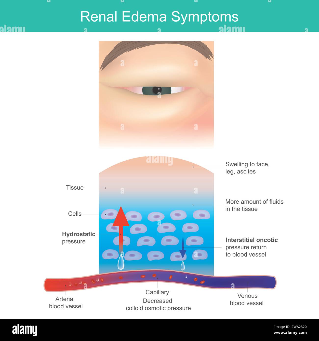 Symptômes de l'oedème rénal. Gonflement sévère le médical appelé œdème, se produisent particulièrement autour des yeux. Illustration de Vecteur
