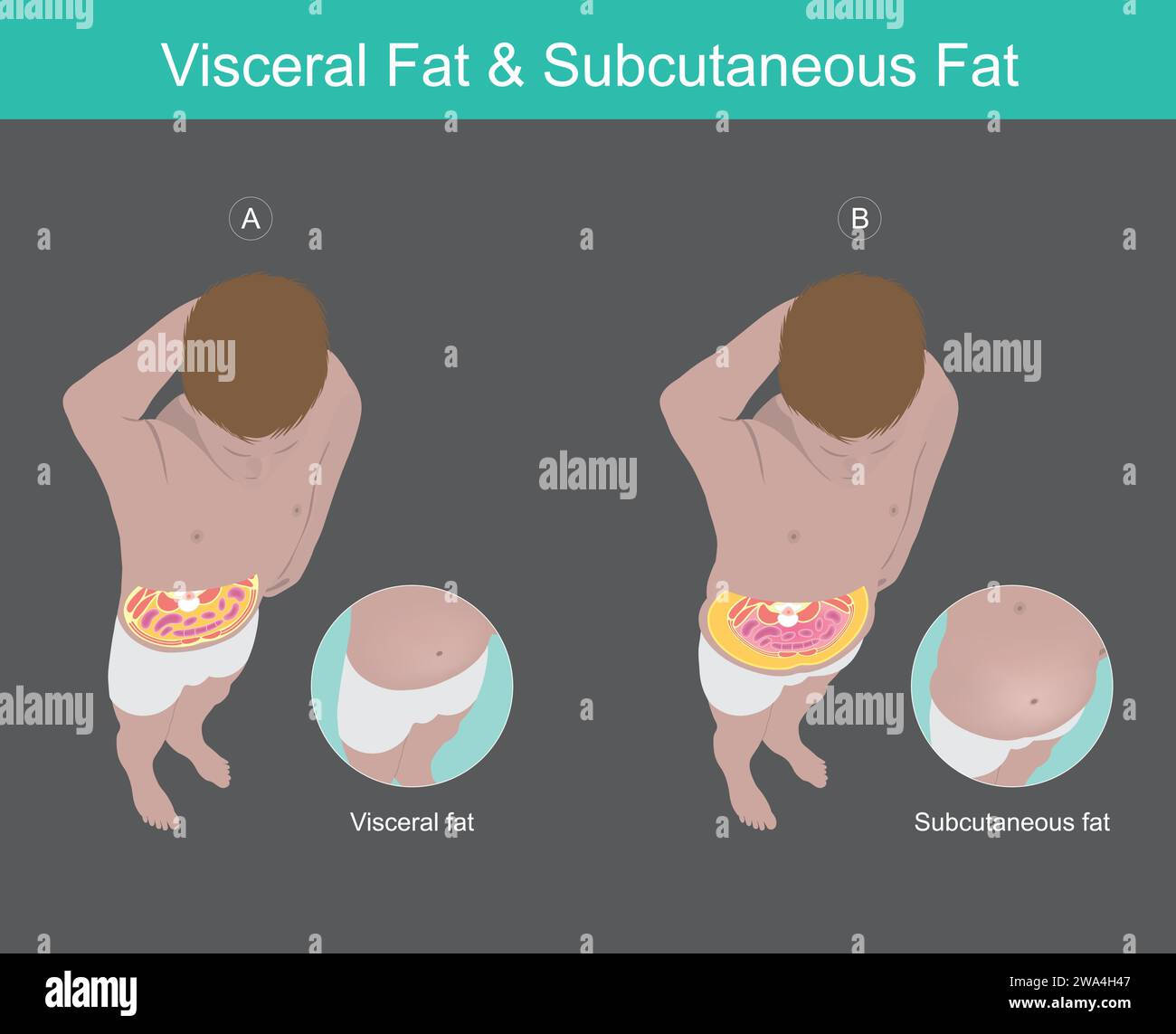 Illustration connaissance de la graisse viscérale abdominale chez l'homme. Illustration de Vecteur