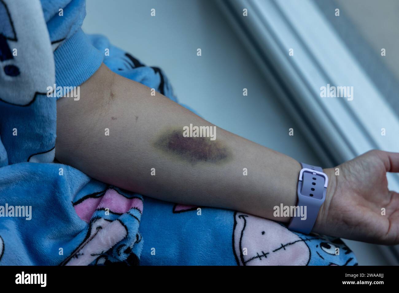 Ecchymoses de canule dans l'avant-bras Banque D'Images