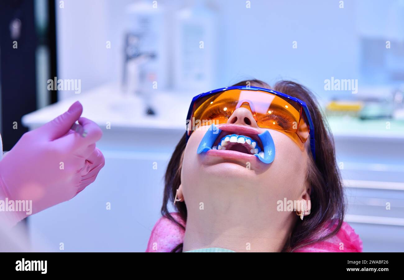 Patient avec écarteur dentaire dans la bouche à l'examen chez le dentiste à la clinique. Concept de procédure de blanchiment des dents. Gros plan Banque D'Images Patient avec écarteur dentaire dans la bouche à l'examen chez le dentiste à la clinique. Concept de procédure de blanchiment des dents. Gros plan Banque D'Images