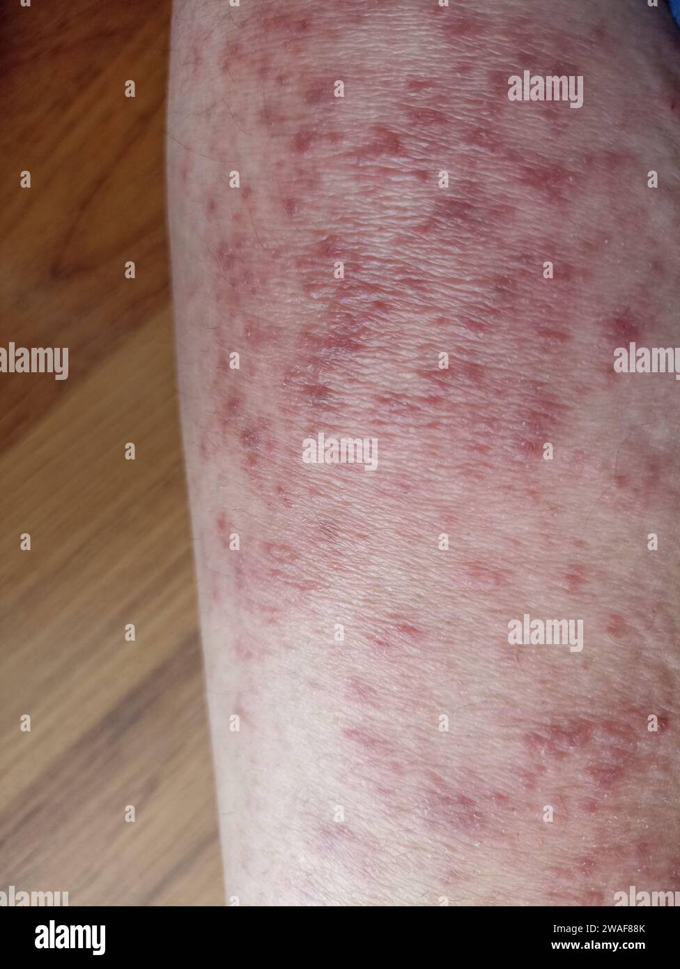 rash eczéma dermatite sur jambe. inflammation de la peau Banque D'Images