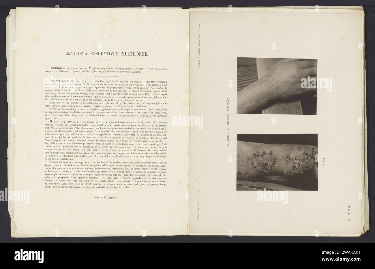 Patients atteints de la maladie de la peau 'erythema exudativum multiforme', c. 1882 - in ou avant 1892 impression photomécanique Amsterdampublisher : peau collotype papier de Haarlem et maladies vénériennes. bras Banque D'Images