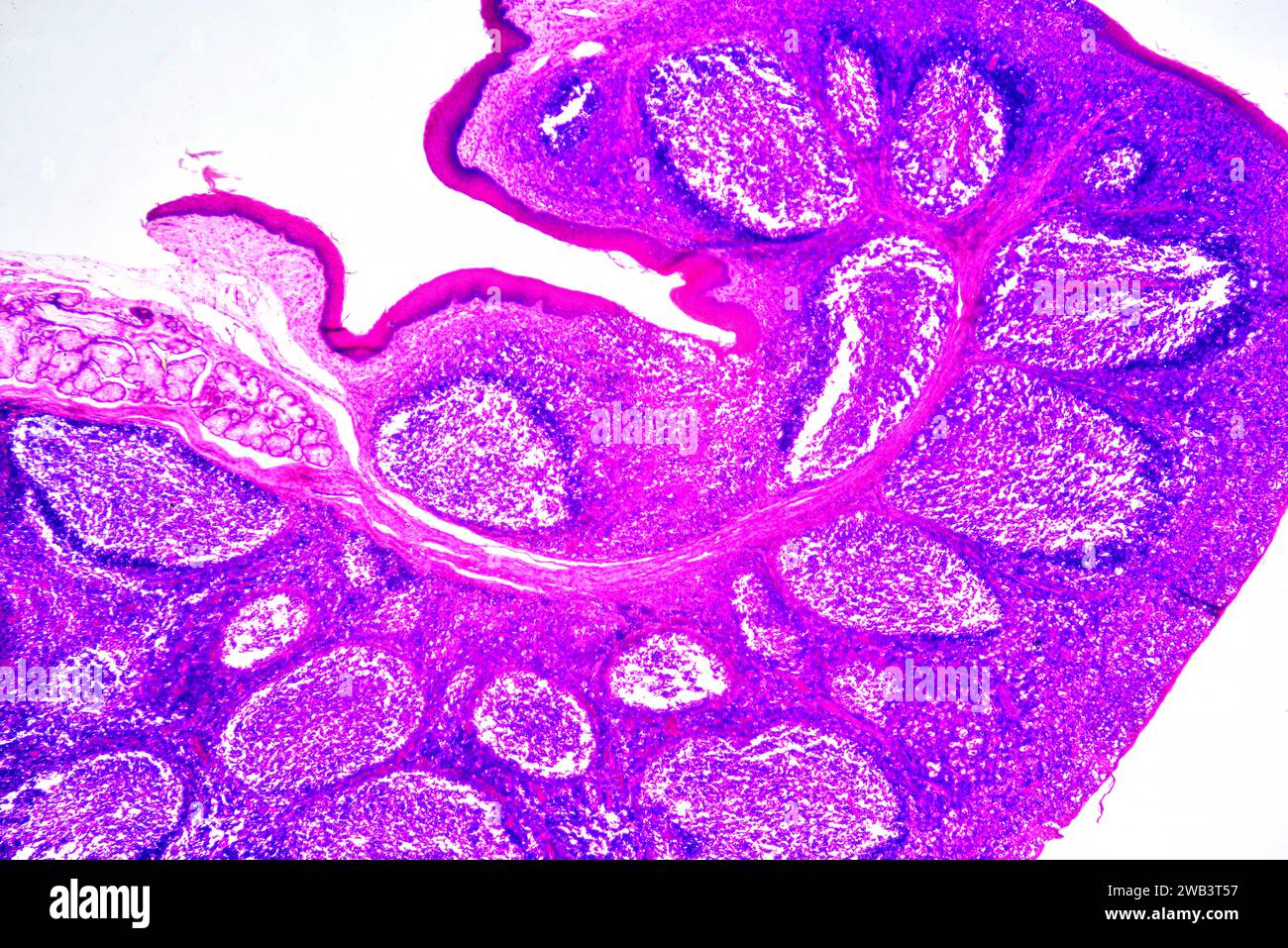 Amygdales palatines humaines montrant des follicules lymphoïdes circulaires et une glande sécrétoire. Micrographie légère, coloration à l'hématoxyline éosine. X30 lors de l'impression 10 Banque D'Images