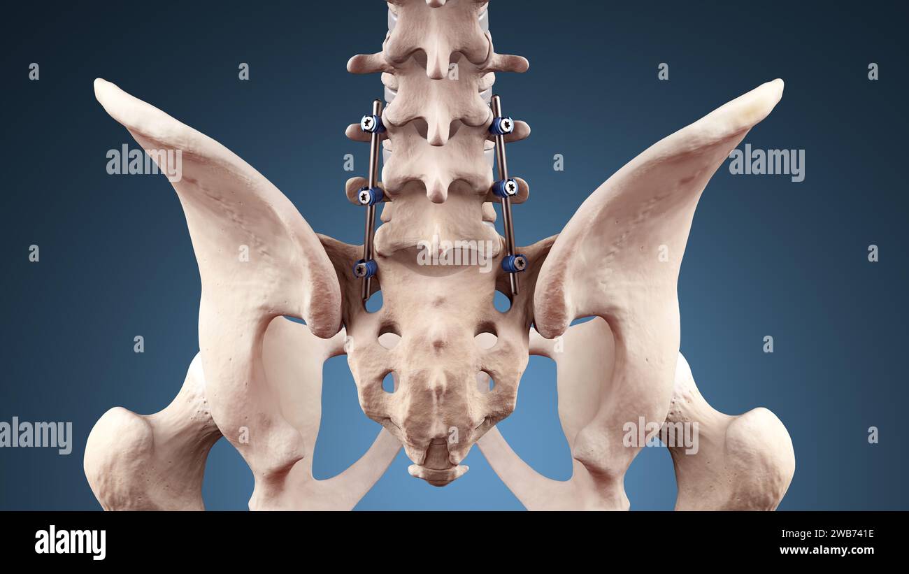 Fusion lombaire postérieure du rachis avec vis pédiculaires et tiges Banque D'Images