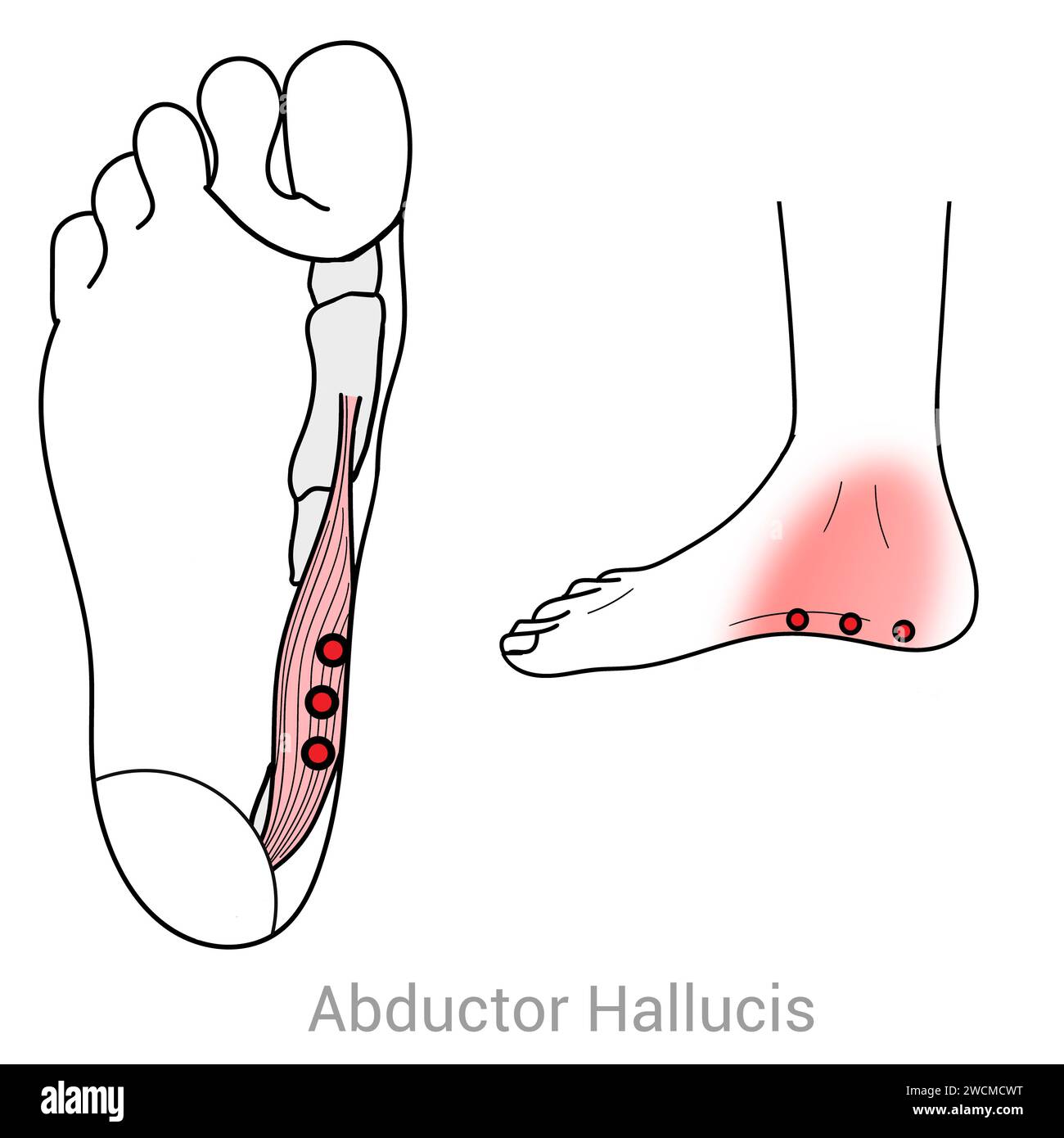 Abductor Hallucis : points déclencheurs myofasciaux et localisations douloureuses associées Banque D'Images