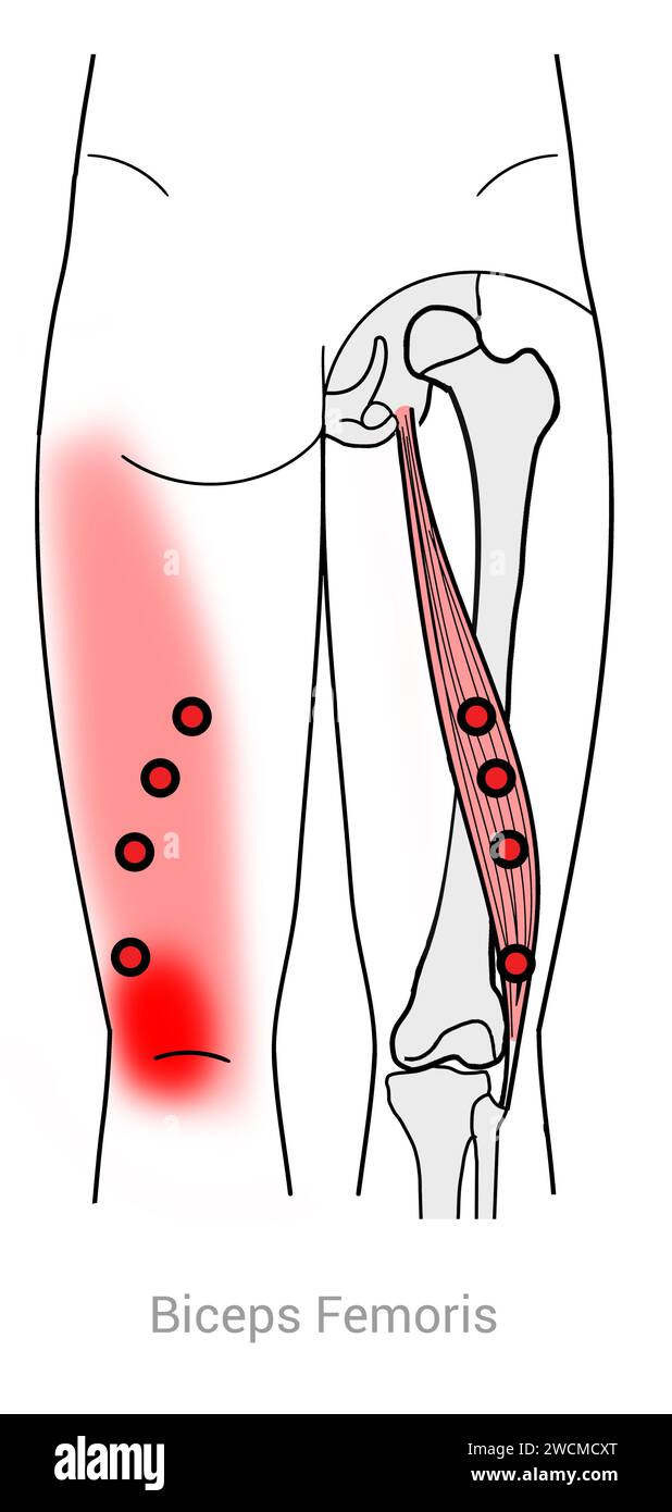 Biceps fémoris : points déclencheurs myofasciaux et localisations douloureuses associées Banque D'Images
