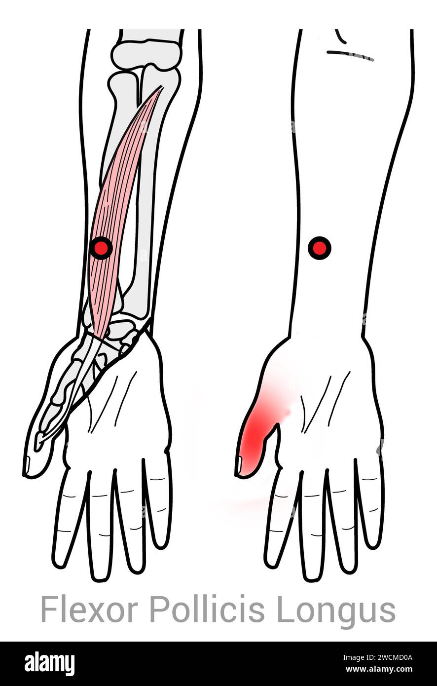 Flexor Pollicis Longus : points déclencheurs myofasciaux et localisations douloureuses associées Banque D'Images