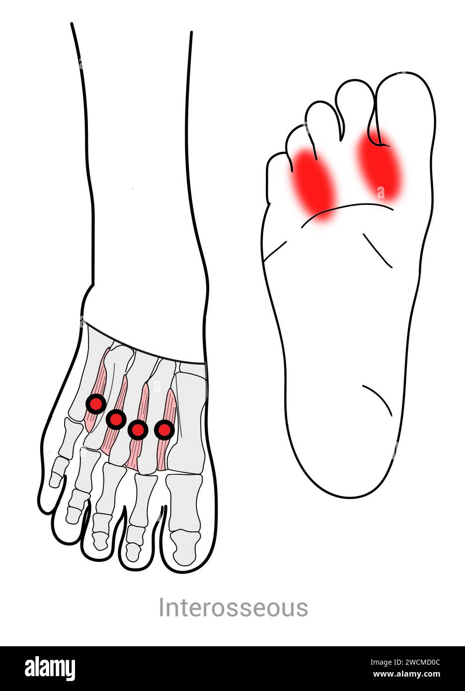 Muscles interosseux pieds : points déclencheurs myofasciaux et localisations douloureuses associées Banque D'Images