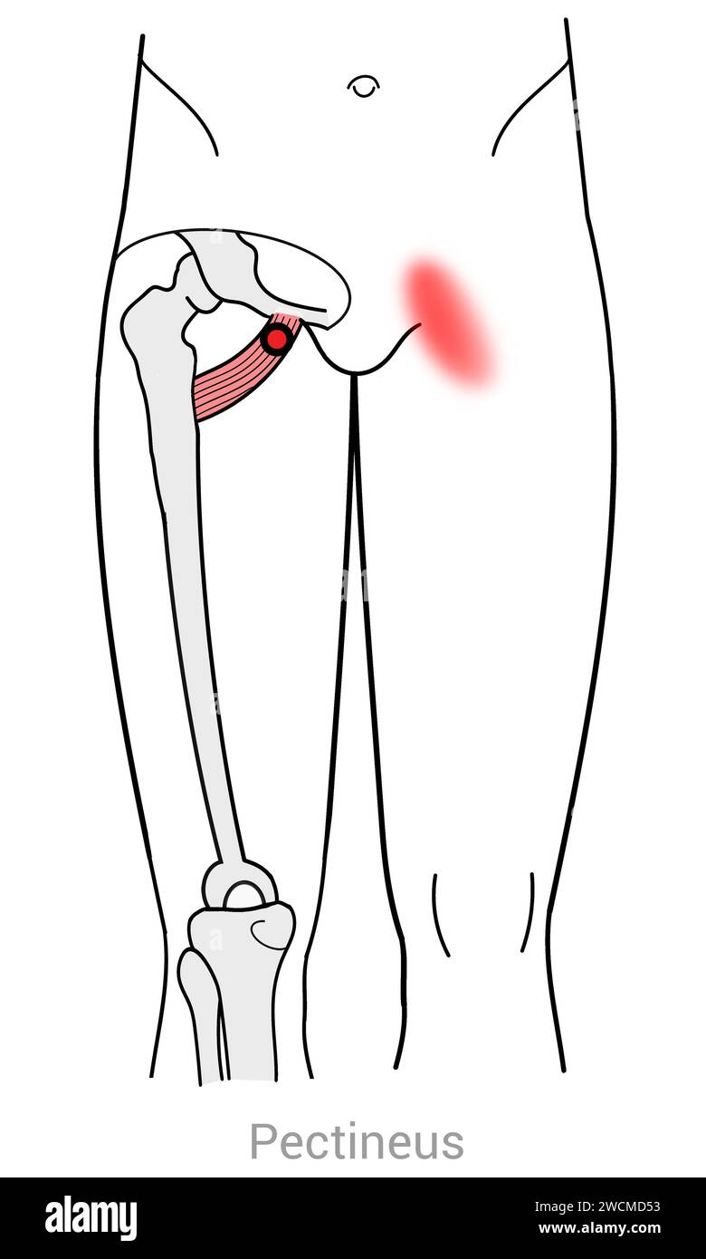 Pectineus : points déclencheurs myofasciaux et localisations douloureuses associées Banque D'Images