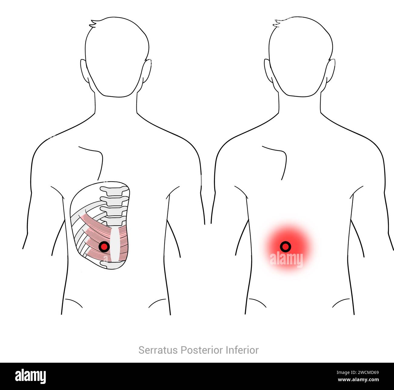 Serratus postérieur inférieur : points déclencheurs myofasciaux et localisations douloureuses associées Banque D'Images