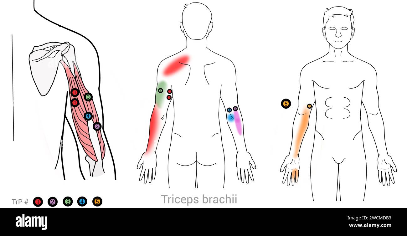 Triceps : points déclencheurs myofasciaux et localisations douloureuses associées Banque D'Images