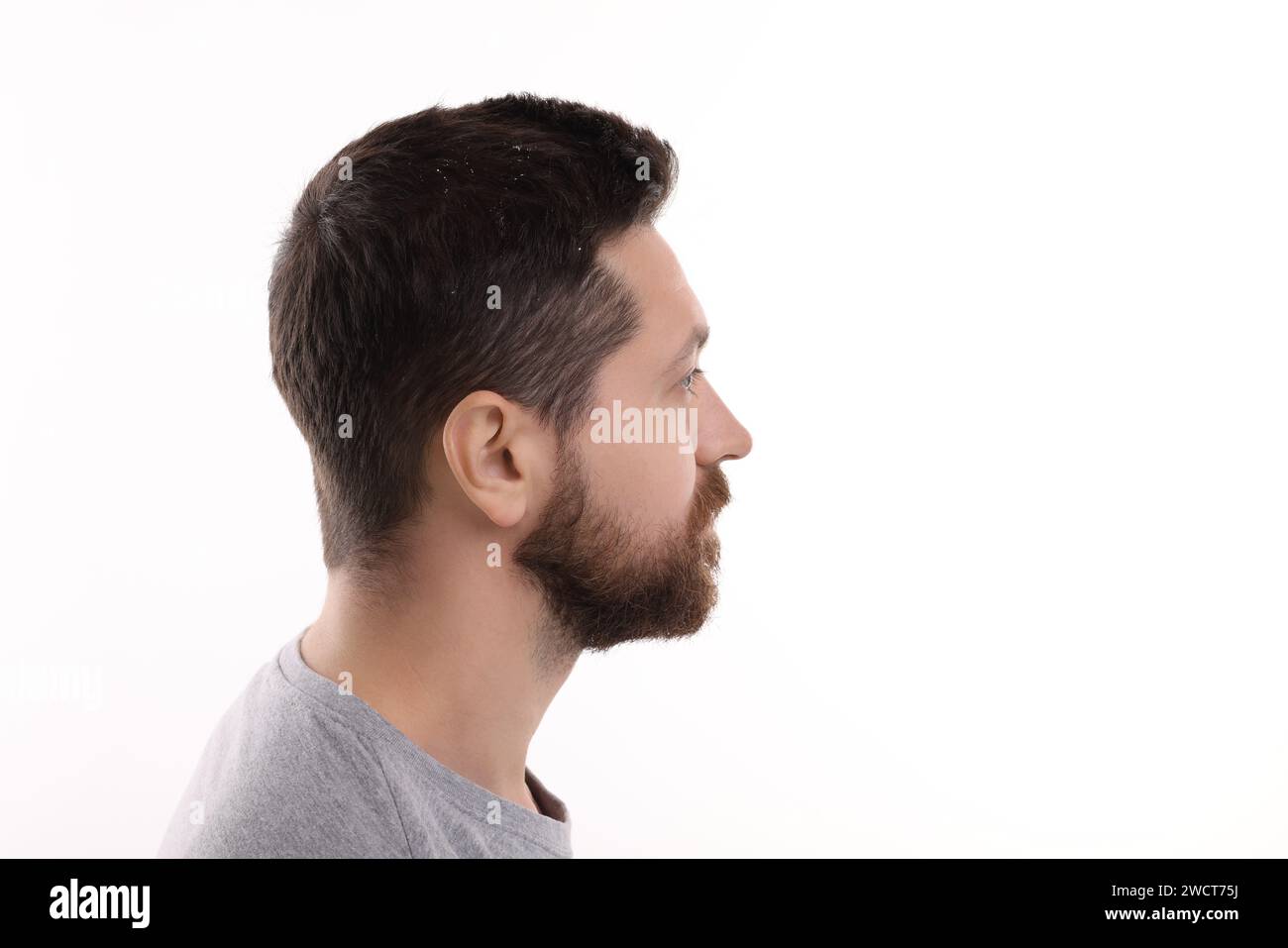 Homme avec des pellicules dans ses cheveux foncés sur fond blanc Banque D'Images