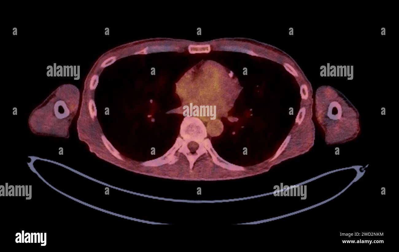 Une image TEP-TDM est une visualisation diagnostique combinant la tomographie par émission de positrons (TEP) et la tomodensitométrie (TDM) pour aider à trouver la cance Banque D'Images