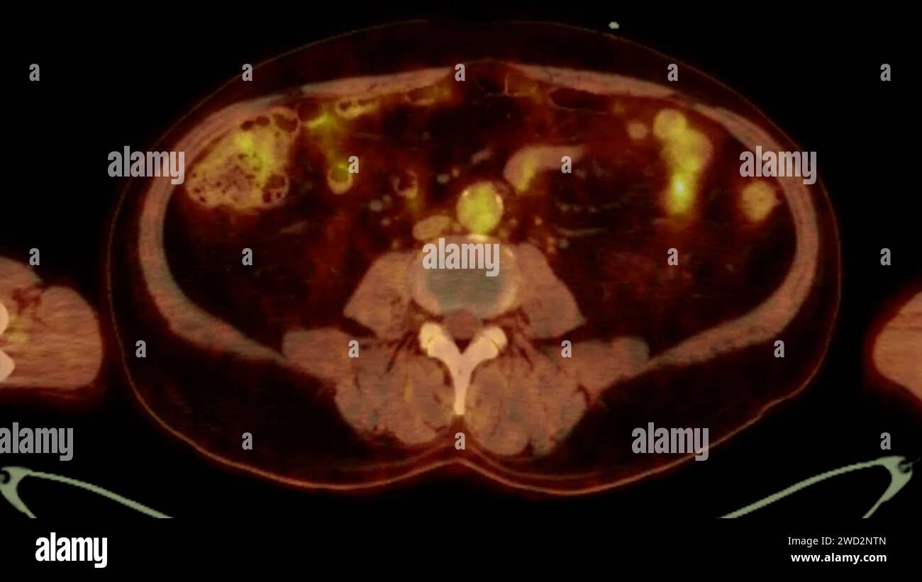Une image TEP-TDM est une visualisation diagnostique combinant la tomographie par émission de positrons (TEP) et la tomodensitométrie (TDM) pour aider à trouver la cance Banque D'Images