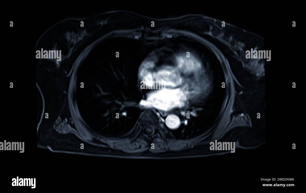 Les images IRM cardiaques sont essentielles pour évaluer la santé cardiaque, identifier les anomalies cardiaques et orienter les plans de traitement. Banque D'Images