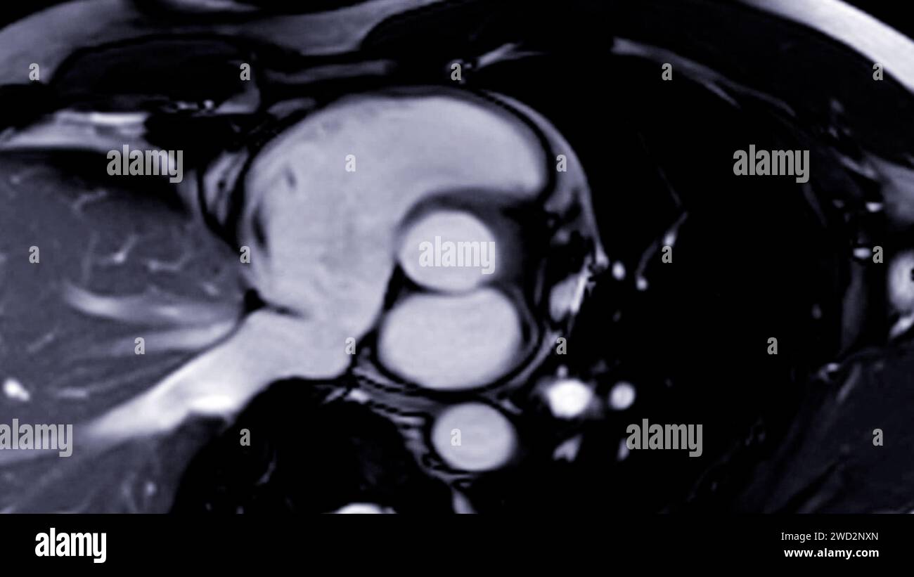 Les images IRM cardiaques sont essentielles pour évaluer la santé cardiaque, identifier les anomalies cardiaques et orienter les plans de traitement. Banque D'Images