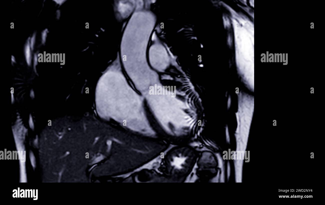 Les images IRM cardiaques sont essentielles pour évaluer la santé cardiaque, identifier les anomalies cardiaques et orienter les plans de traitement. Banque D'Images