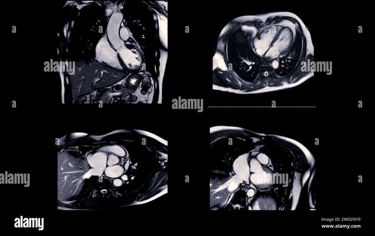 Les images IRM cardiaques sont essentielles pour évaluer la santé cardiaque, identifier les anomalies cardiaques et orienter les plans de traitement. Banque D'Images