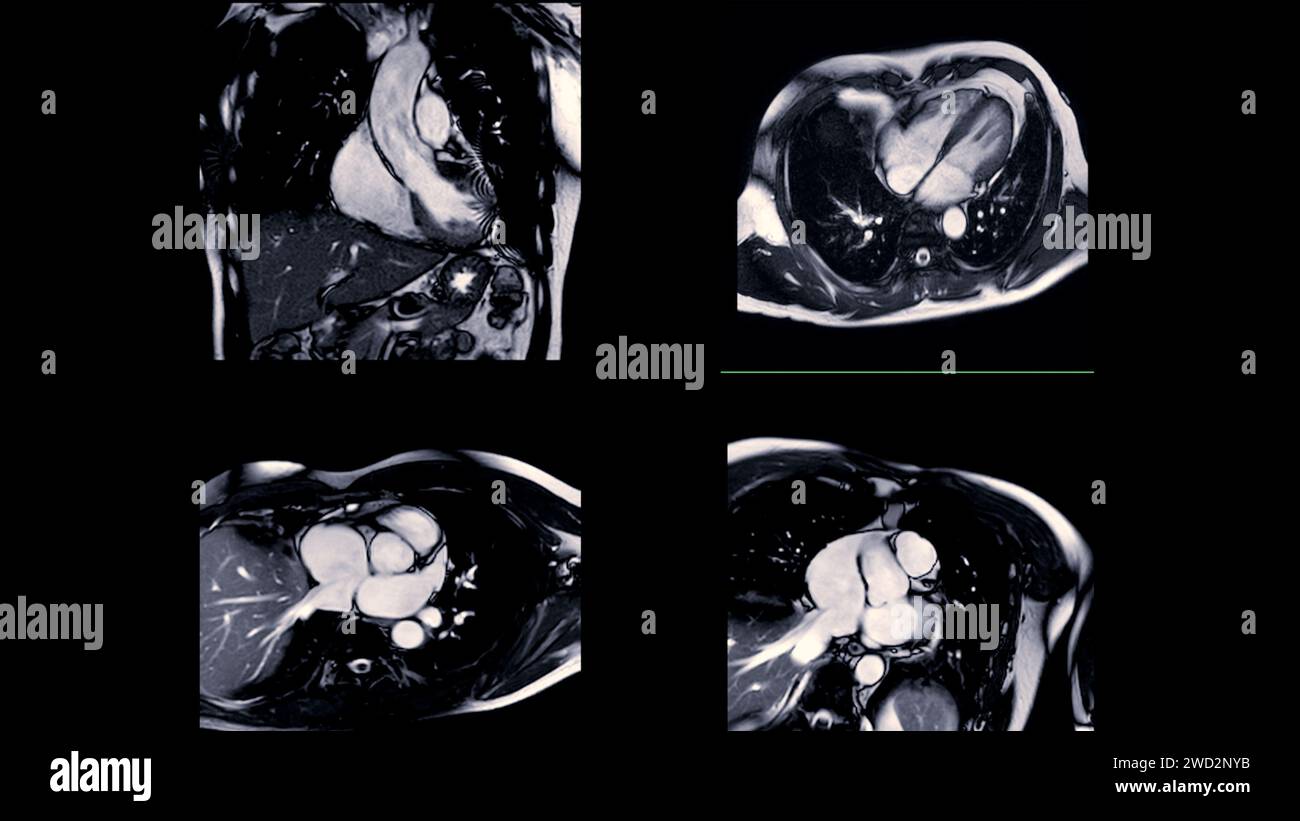 Les images IRM cardiaques sont essentielles pour évaluer la santé cardiaque, identifier les anomalies cardiaques et orienter les plans de traitement. Banque D'Images