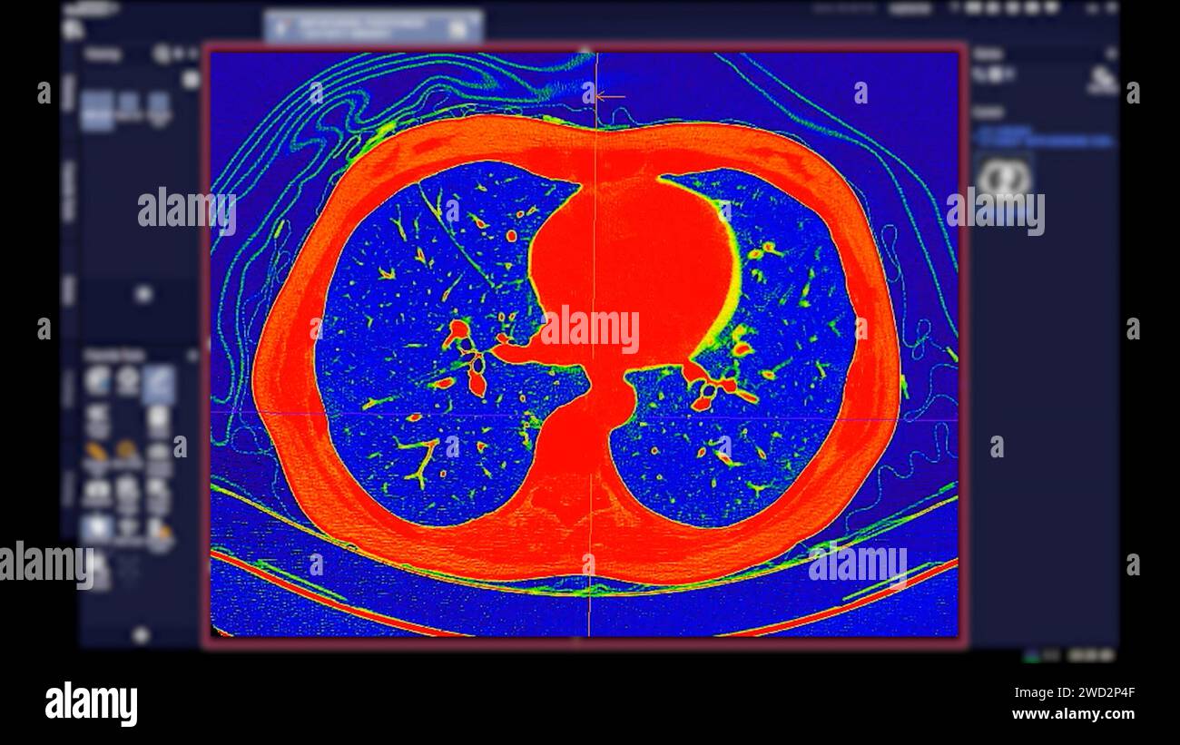 Tomodensitométrie de la vue axiale thorax en mode couleur pour le diagnostic d'embolie pulmonaire (EP) , de cancer du poumon et de covid-19. Banque D'Images