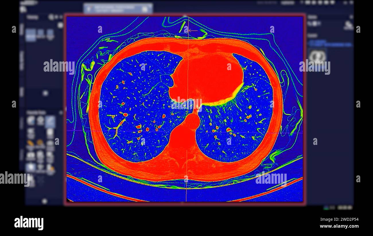 Tomodensitométrie de la vue axiale thorax en mode couleur pour le diagnostic d'embolie pulmonaire (EP) , de cancer du poumon et de covid-19. Banque D'Images