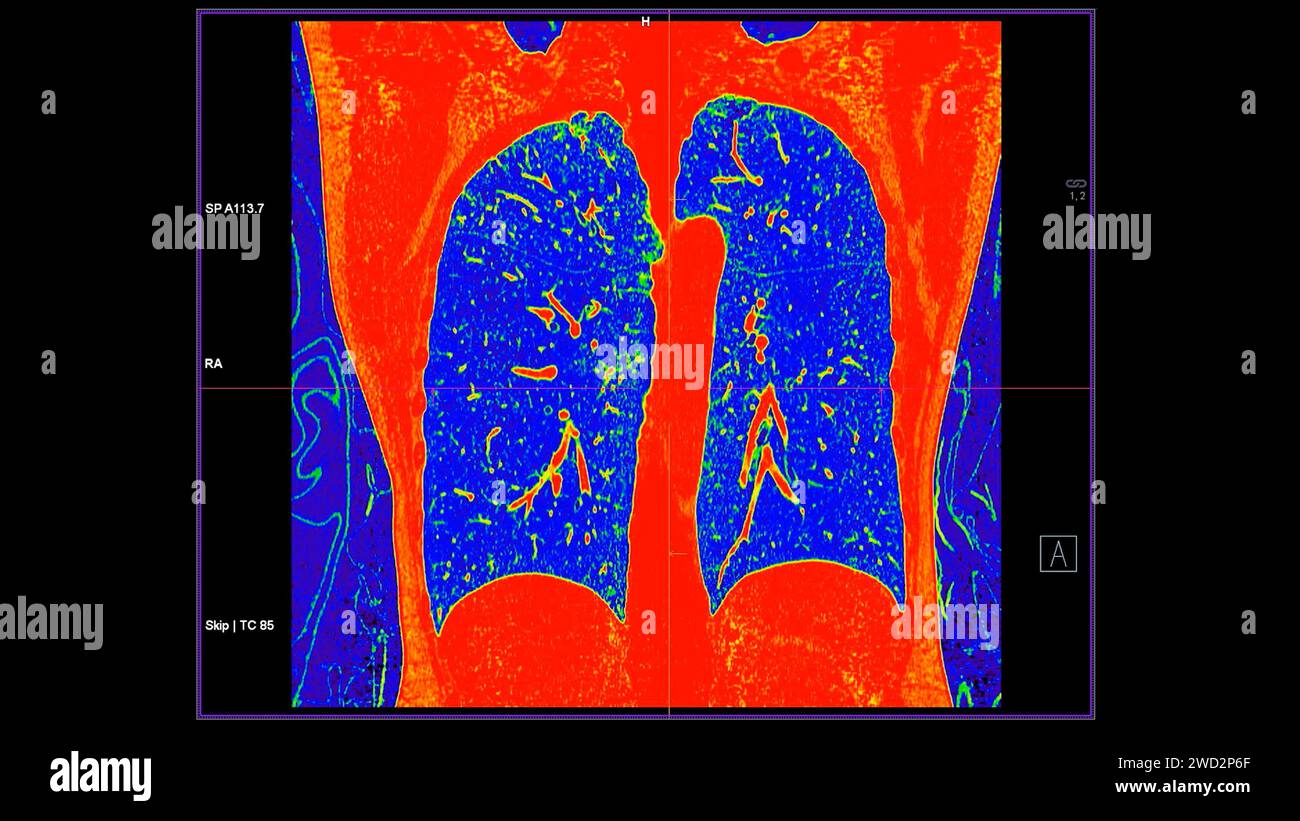 Tomodensitométrie de la vue coronale thorax en mode couleur pour le diagnostic d'embolie pulmonaire (EP) , de cancer du poumon et de covid-19. Banque D'Images