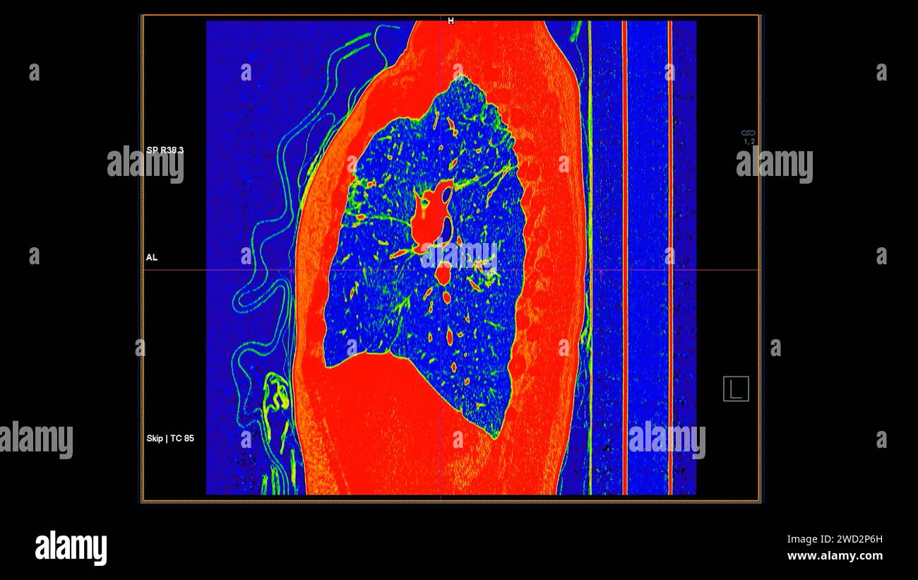 Tomodensitométrie de la vue sagittale thorax en mode couleur pour le diagnostic d'embolie pulmonaire (EP) , de cancer du poumon et de covid-19. Banque D'Images