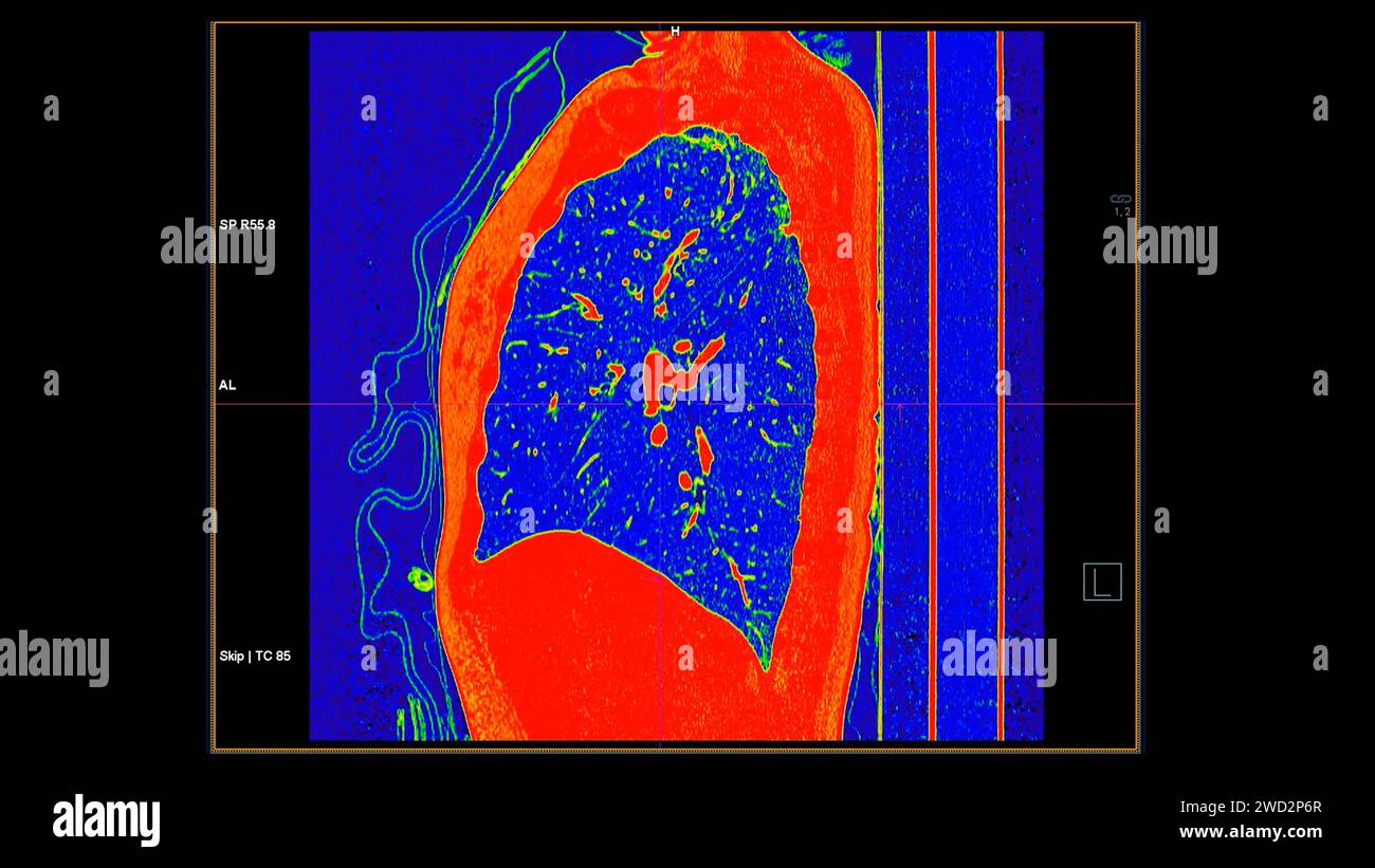 Tomodensitométrie de la vue sagittale thorax en mode couleur pour le diagnostic d'embolie pulmonaire (EP) , de cancer du poumon et de covid-19. Banque D'Images