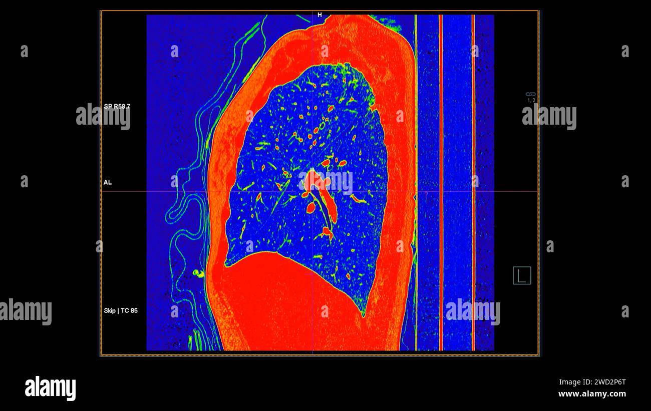 Tomodensitométrie de la vue sagittale thorax en mode couleur pour le diagnostic d'embolie pulmonaire (EP) , de cancer du poumon et de covid-19. Banque D'Images