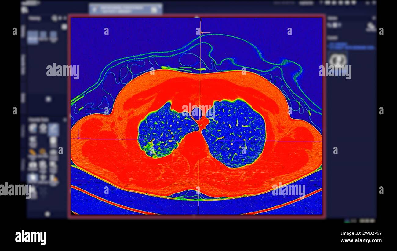 Tomodensitométrie de la vue axiale thorax en mode couleur pour le diagnostic d'embolie pulmonaire (EP) , de cancer du poumon et de covid-19. Banque D'Images