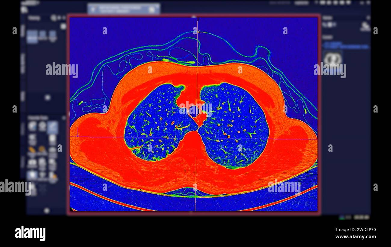 Tomodensitométrie de la vue axiale thorax en mode couleur pour le diagnostic d'embolie pulmonaire (EP) , de cancer du poumon et de covid-19. Banque D'Images