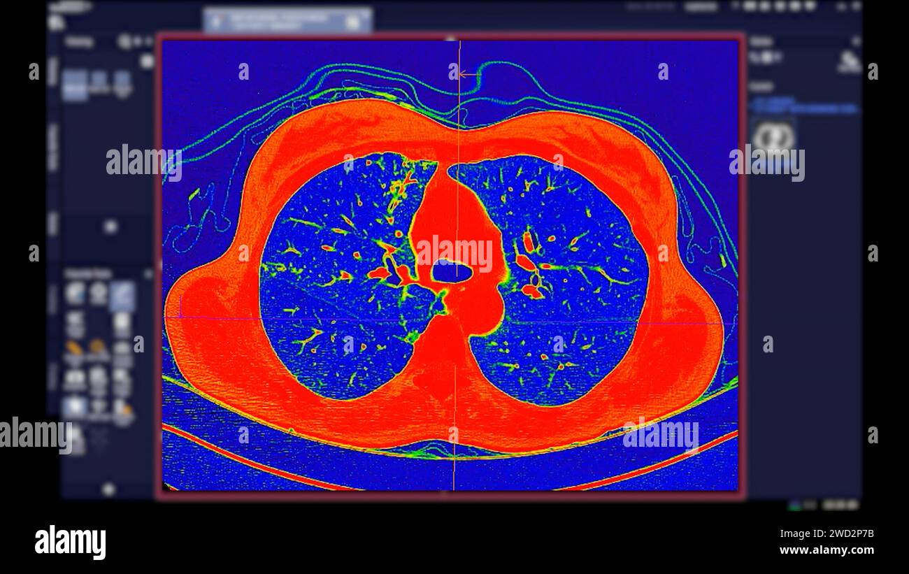 Tomodensitométrie de la vue axiale thorax en mode couleur pour le diagnostic d'embolie pulmonaire (EP) , de cancer du poumon et de covid-19. Banque D'Images