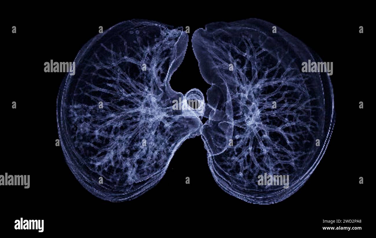Image CT thorax or Lung 3D montrant la trachée et le poumon dans le système respiratoire. Banque D'Images