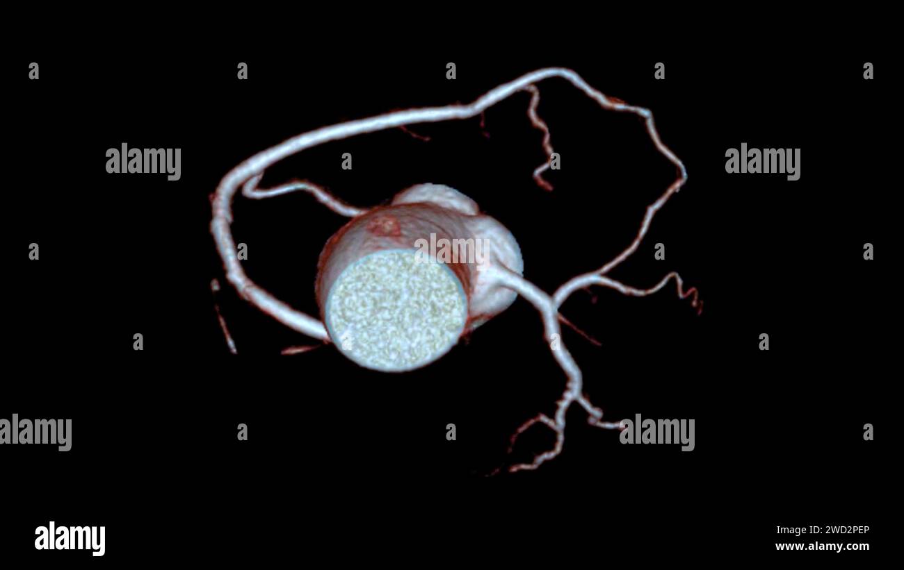 Le rendu 3D de l'artère coronaire CTA est une technique d'imagerie diagnostique qui capture des images détaillées des vaisseaux sanguins du cœur pour diagnostiquer l'arte coronaire Banque D'Images