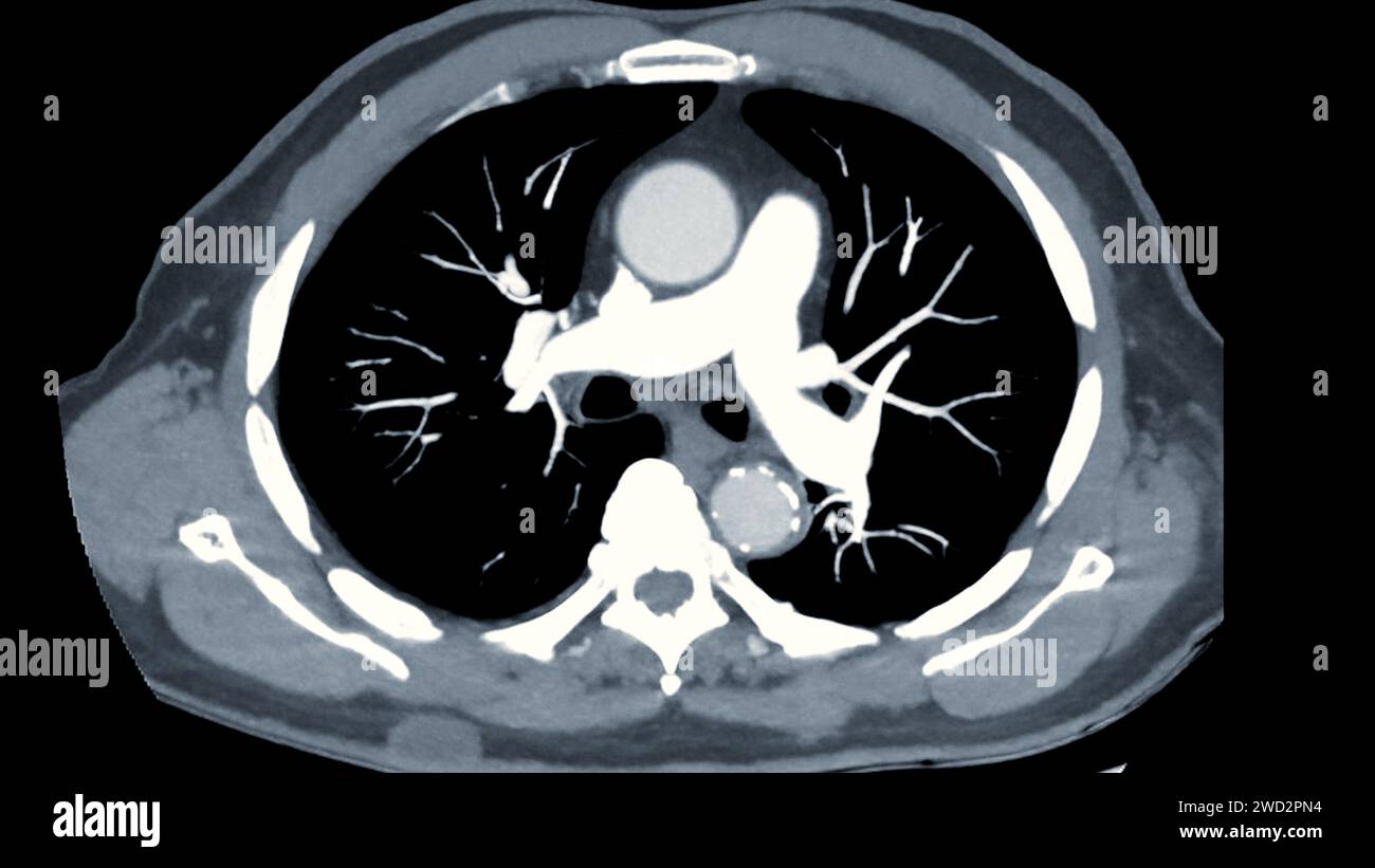 Artère pulmonaire CTPA ou CTA. Cette technique d'imagerie offre une vue claire des artères pulmonaires, facilitant le diagnostic de l'embolie pulmonaire, des canaux Banque D'Images