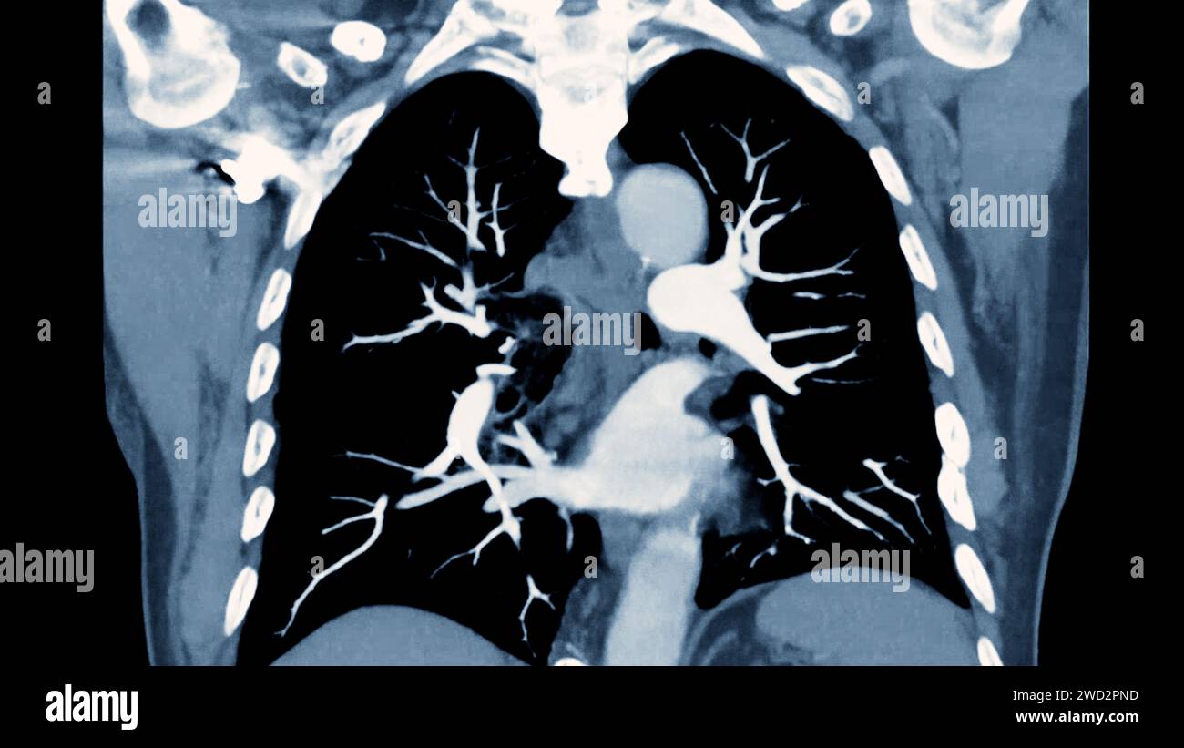 Artère pulmonaire CTPA ou CTA. Cette technique d'imagerie offre une vue claire des artères pulmonaires, facilitant le diagnostic de l'embolie pulmonaire, des canaux Banque D'Images