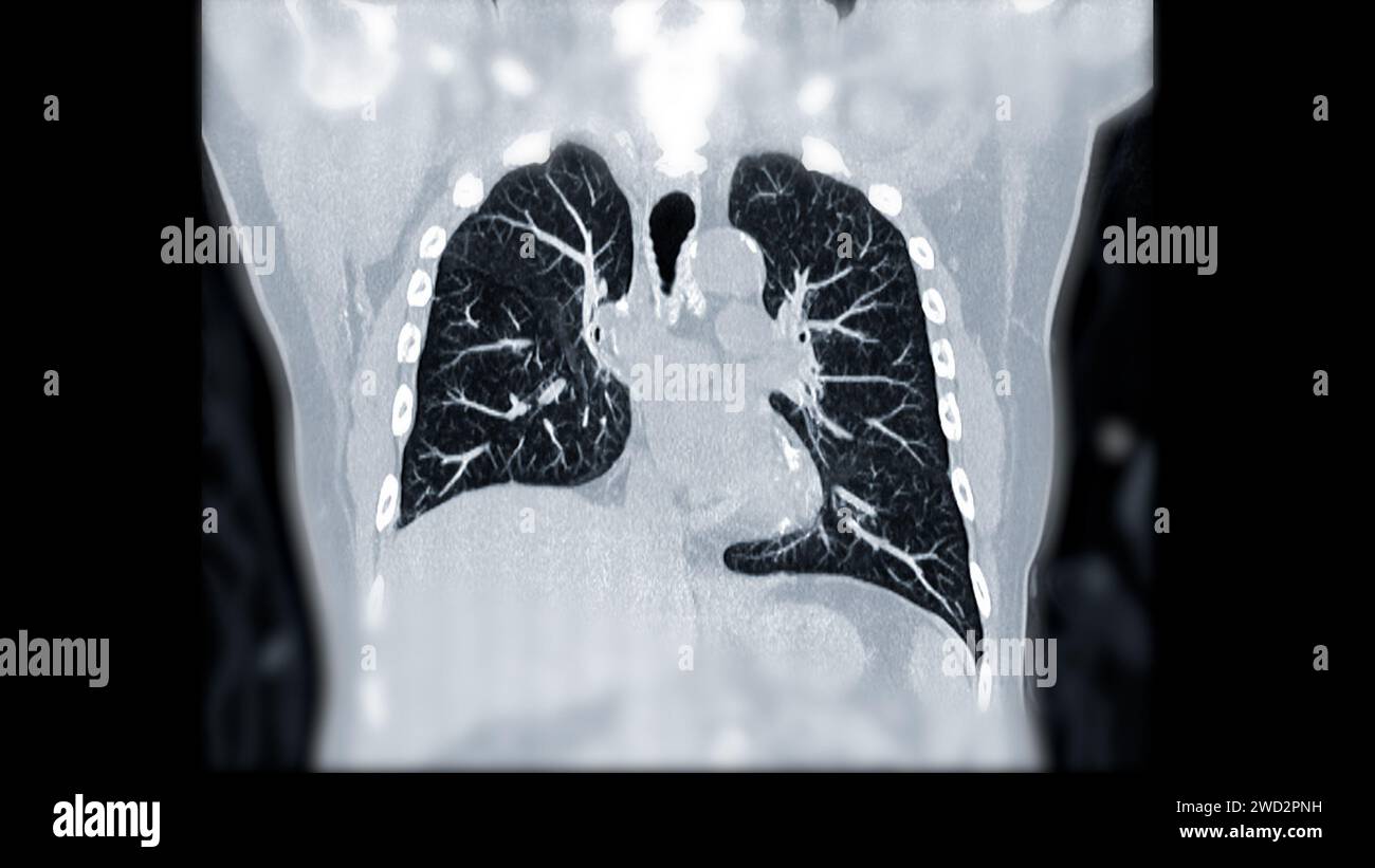 Artère pulmonaire CTPA ou CTA. Cette technique d'imagerie offre une vue claire des artères pulmonaires, facilitant le diagnostic de l'embolie pulmonaire, des canaux Banque D'Images