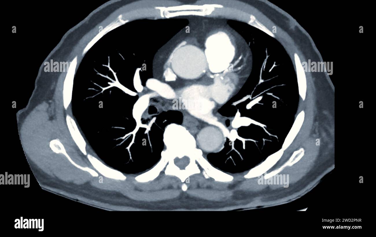 Artère pulmonaire CTPA ou CTA. Cette technique d'imagerie offre une vue claire des artères pulmonaires, facilitant le diagnostic de l'embolie pulmonaire, des canaux Banque D'Images