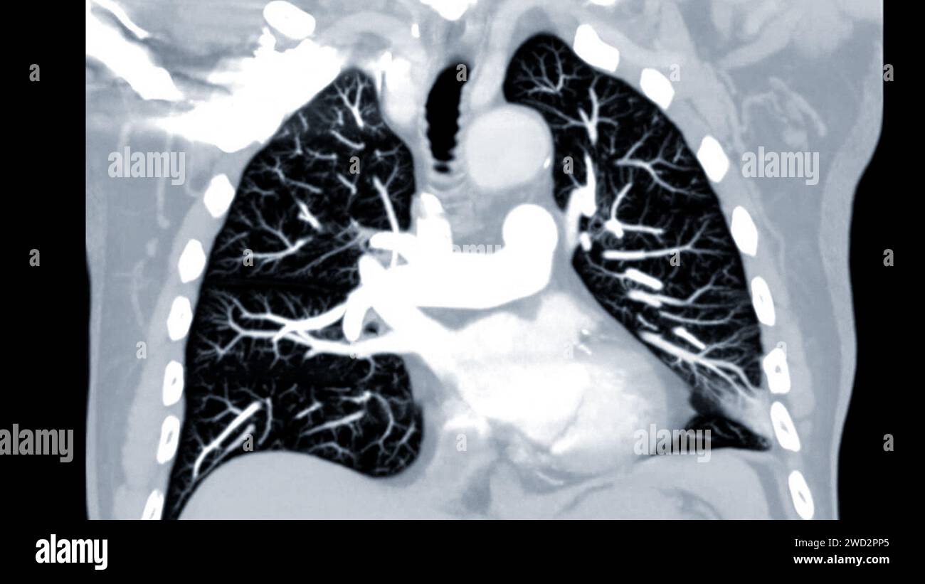 Artère pulmonaire CTPA ou CTA. Cette technique d'imagerie offre une vue claire des artères pulmonaires, facilitant le diagnostic de l'embolie pulmonaire, des canaux Banque D'Images