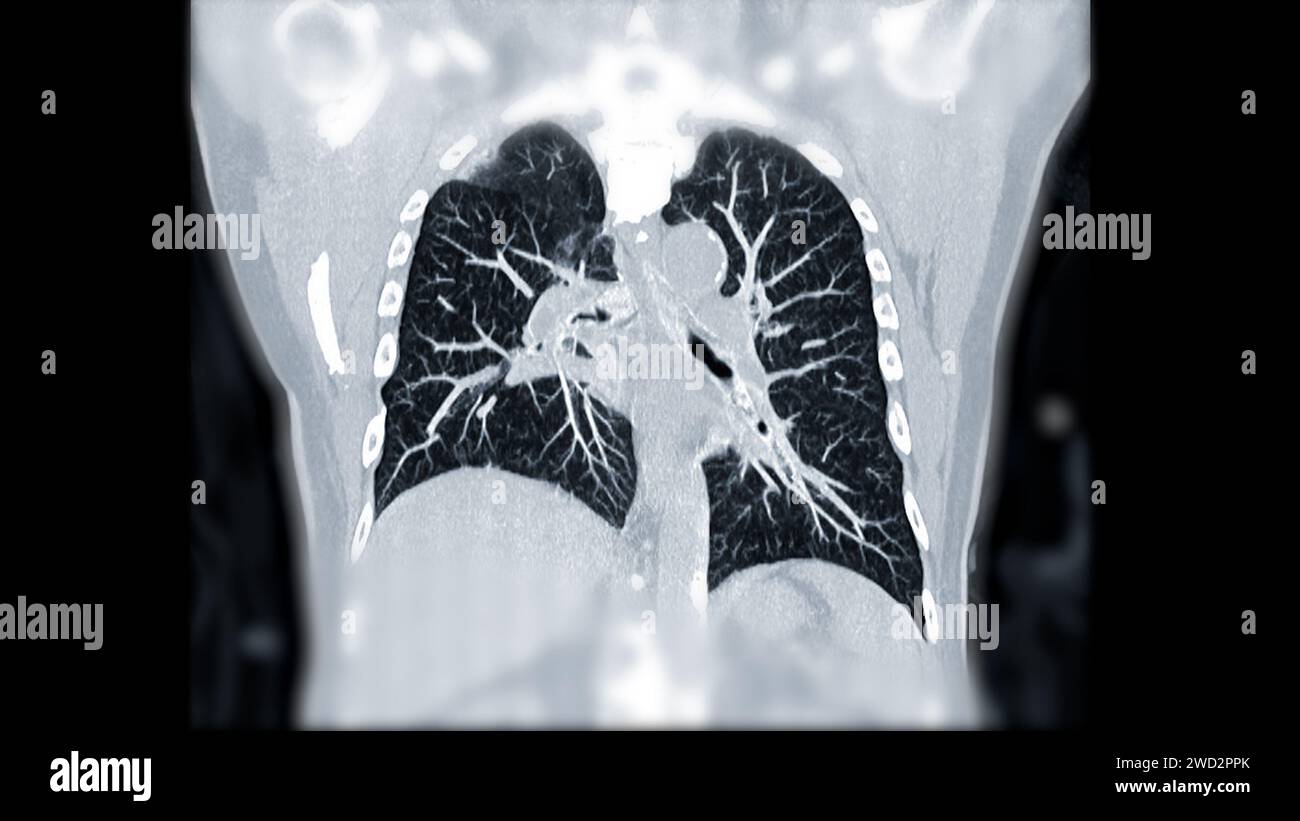 Artère pulmonaire CTPA ou CTA. Cette technique d'imagerie offre une vue claire des artères pulmonaires, facilitant le diagnostic de l'embolie pulmonaire, des canaux Banque D'Images