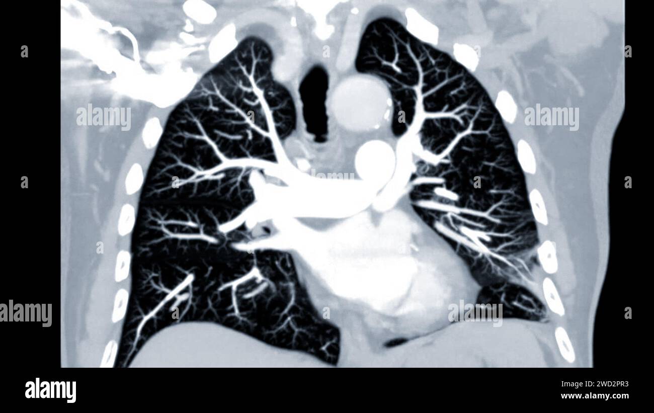 Artère pulmonaire CTPA ou CTA. Cette technique d'imagerie offre une vue claire des artères pulmonaires, facilitant le diagnostic de l'embolie pulmonaire, des canaux Banque D'Images