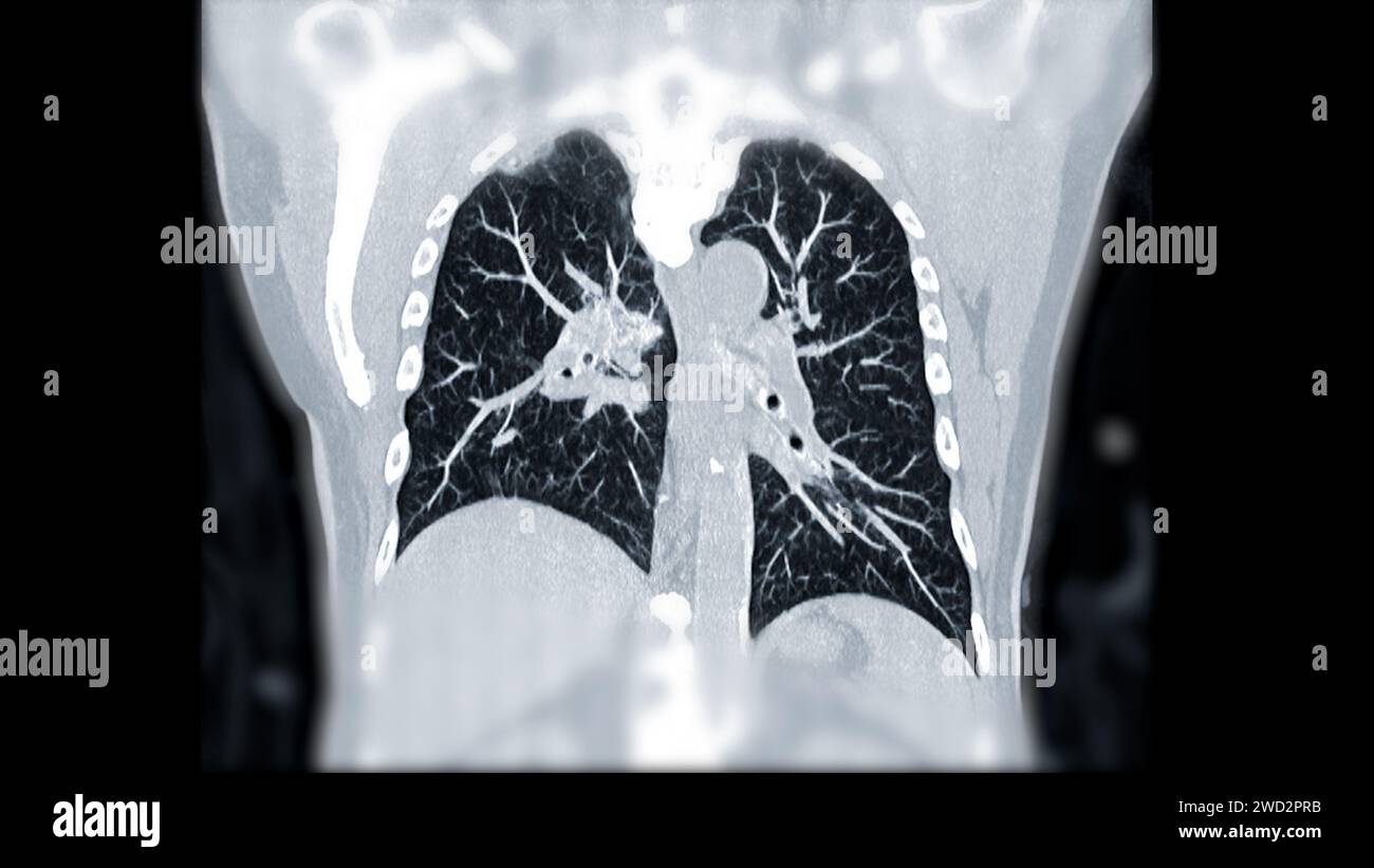 Artère pulmonaire CTPA ou CTA. Cette technique d'imagerie offre une vue claire des artères pulmonaires, facilitant le diagnostic de l'embolie pulmonaire, des canaux Banque D'Images