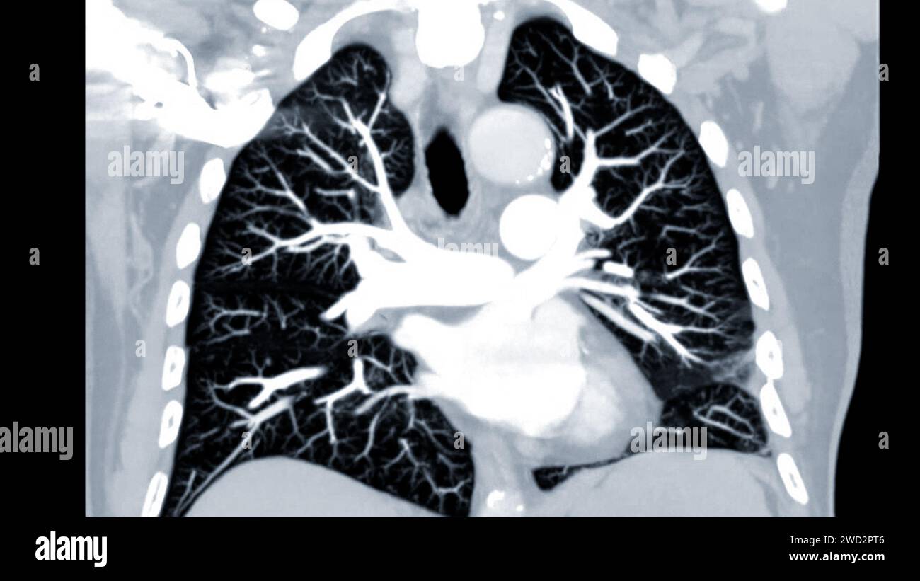 Artère pulmonaire CTPA ou CTA. Cette technique d'imagerie offre une vue claire des artères pulmonaires, facilitant le diagnostic de l'embolie pulmonaire, des canaux Banque D'Images