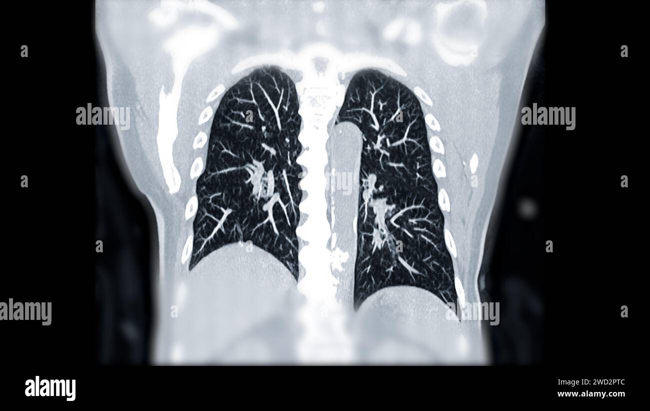 Artère pulmonaire CTPA ou CTA. Cette technique d'imagerie offre une vue claire des artères pulmonaires, facilitant le diagnostic de l'embolie pulmonaire, des canaux Banque D'Images
