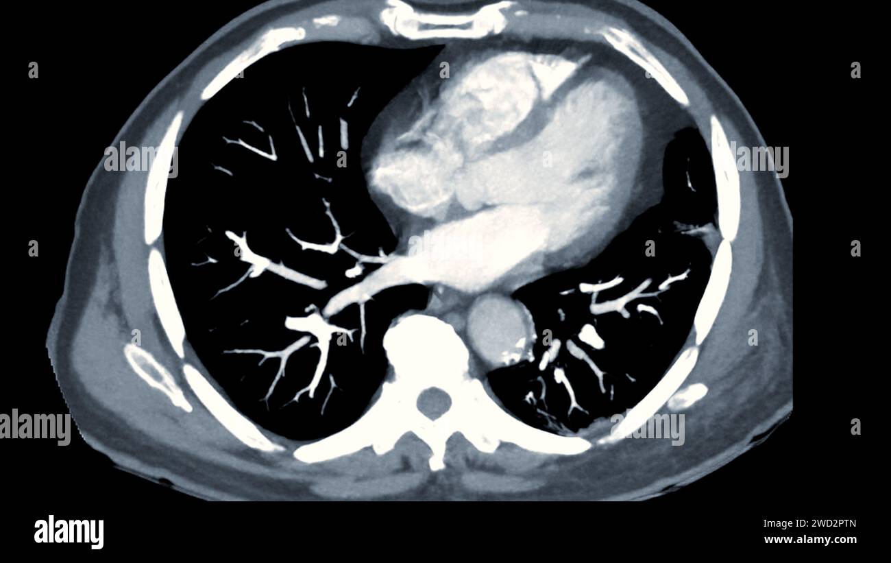 Artère pulmonaire CTPA ou CTA. Cette technique d'imagerie offre une vue claire des artères pulmonaires, facilitant le diagnostic de l'embolie pulmonaire, des canaux Banque D'Images